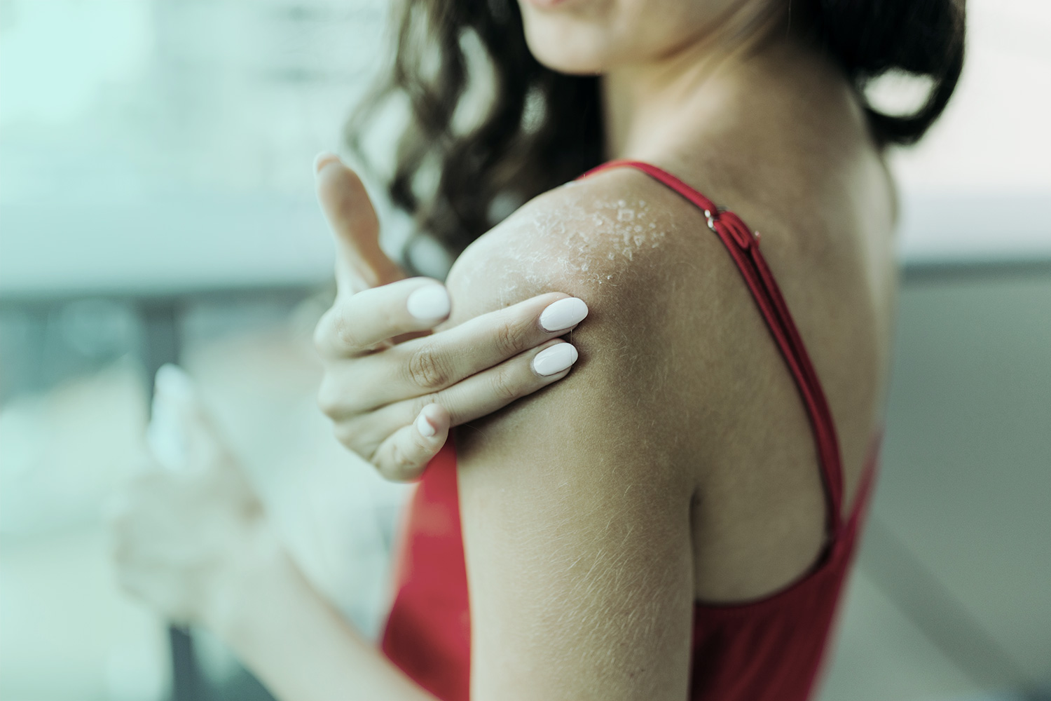 Persona con la piel quemada, expuesta a un posible cáncer de piel.